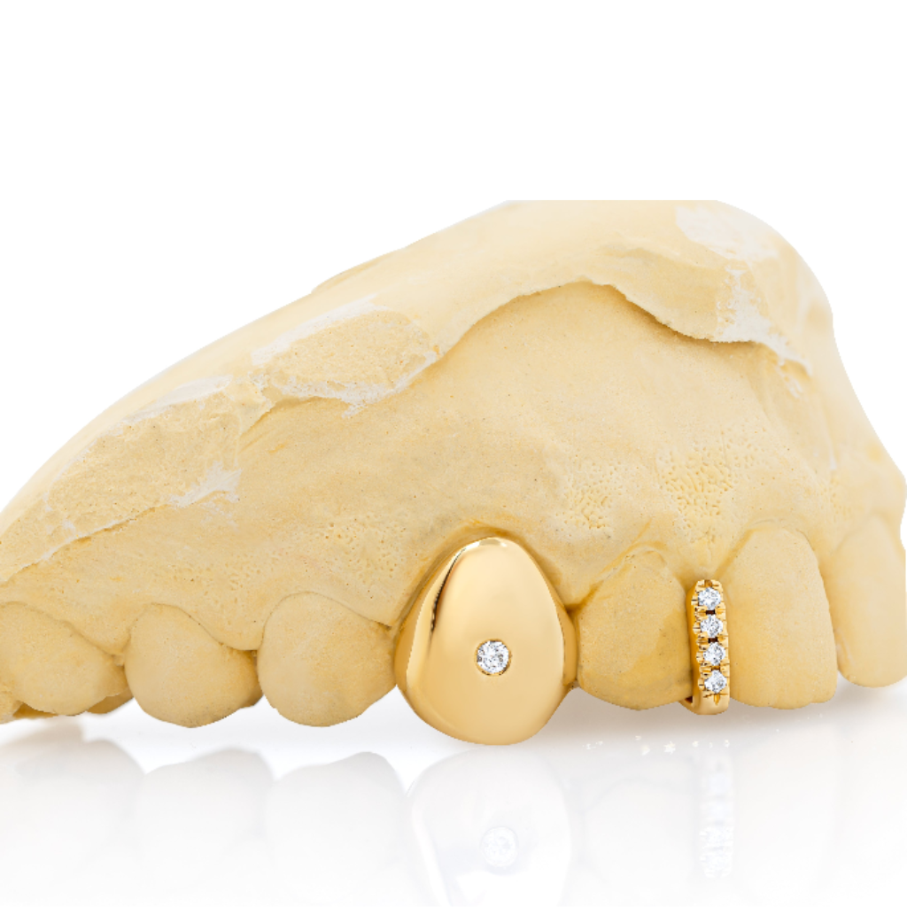 Gold grillz with embedded diamond-studded grills